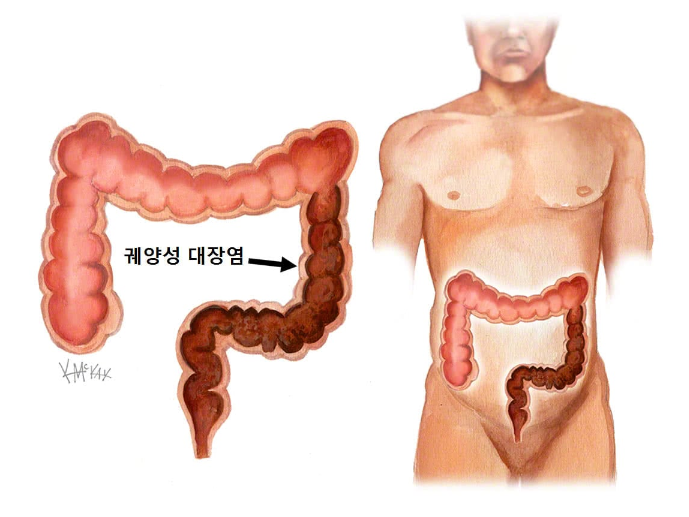 궤양성 장염