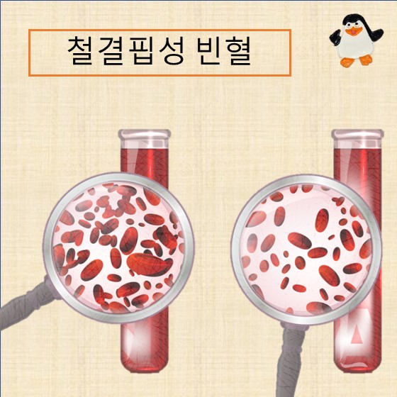 철결핍성 빈혈(iron deficiency anemia), 증상 원인 진단방법 검사방법 치료방법 좋은 음식과 약물
