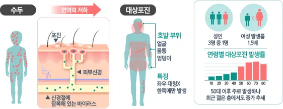 대상포진 병원어떤과로가나요