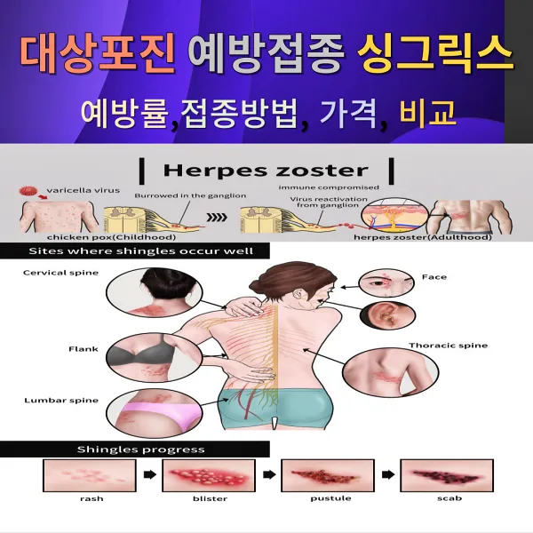 대상포진의 증상 부위와 진행 과정을 보여주는 사진이 보인다. 사진 위로는 &#39;대상포진 예방접종 싱그릭스&#44; 예방률&#44; 접종방법&#44; 가격&#44; 비교&#39;라는 문구가 보인다.