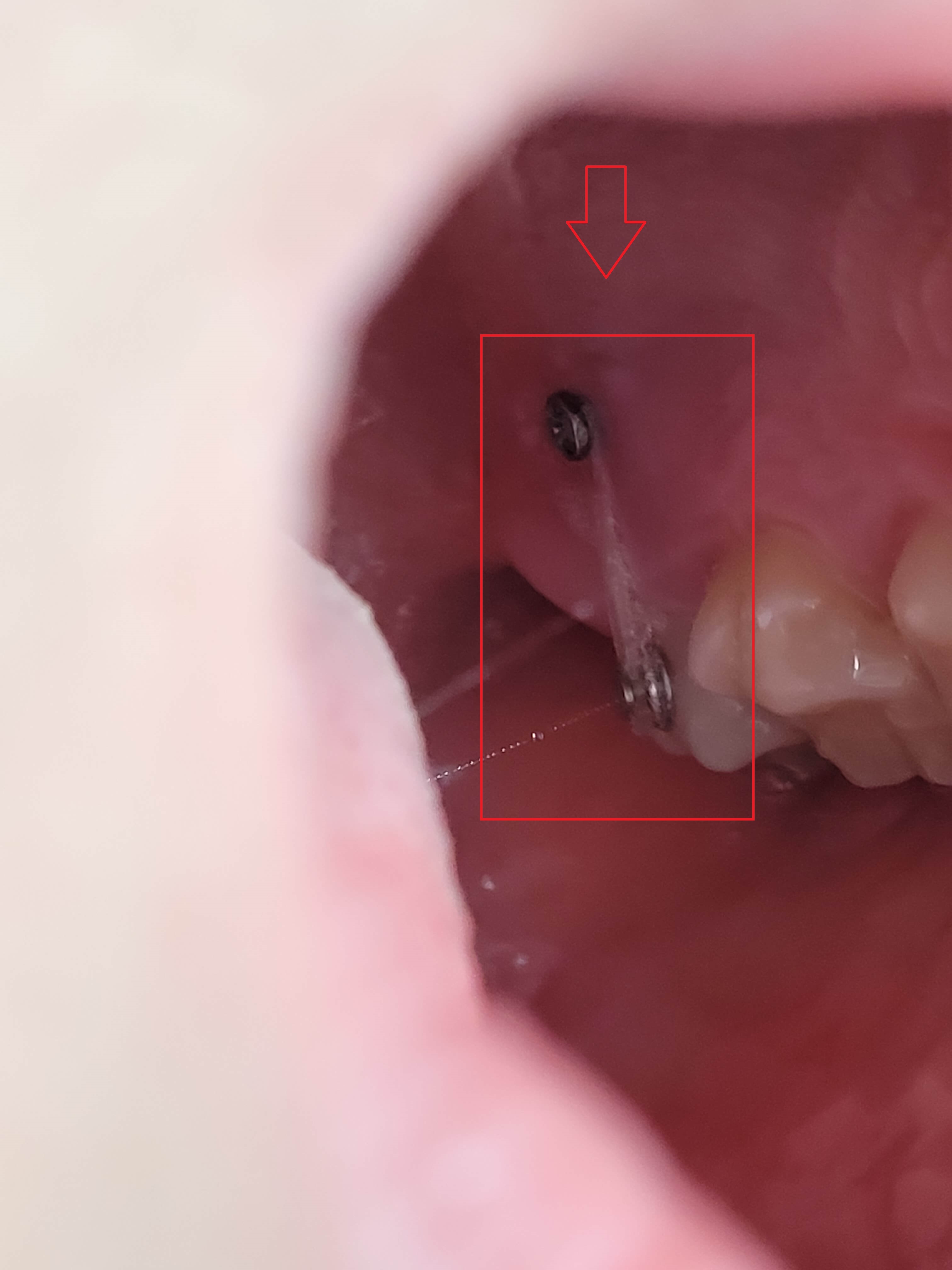 부정교합 가위교합 과개교합 치아교정 후기10