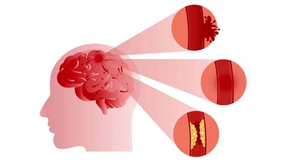 뇌혈관질환 뇌졸중 예방에 도움이 되는 우황청심원 효능 효과