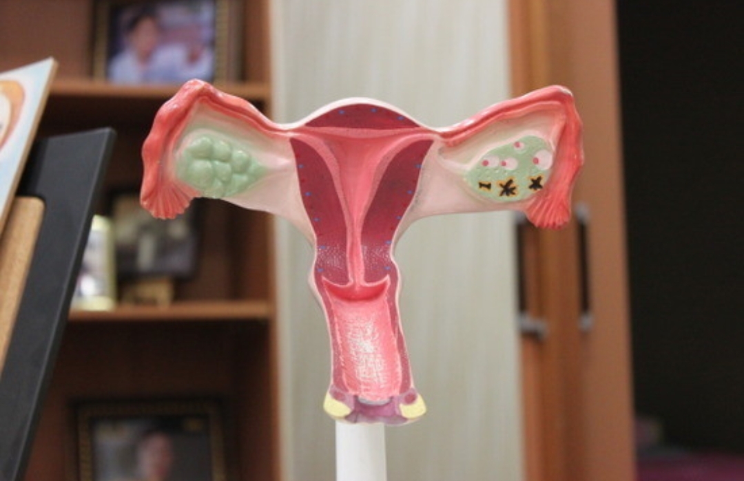  자궁내막증 증상 원인 치료방법