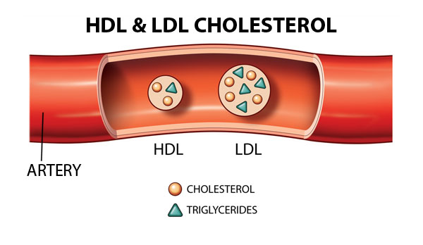 콜레스테롤 HDL과 LDL&#44; 그리고 그 안에 든 중성지방을 그린 그림