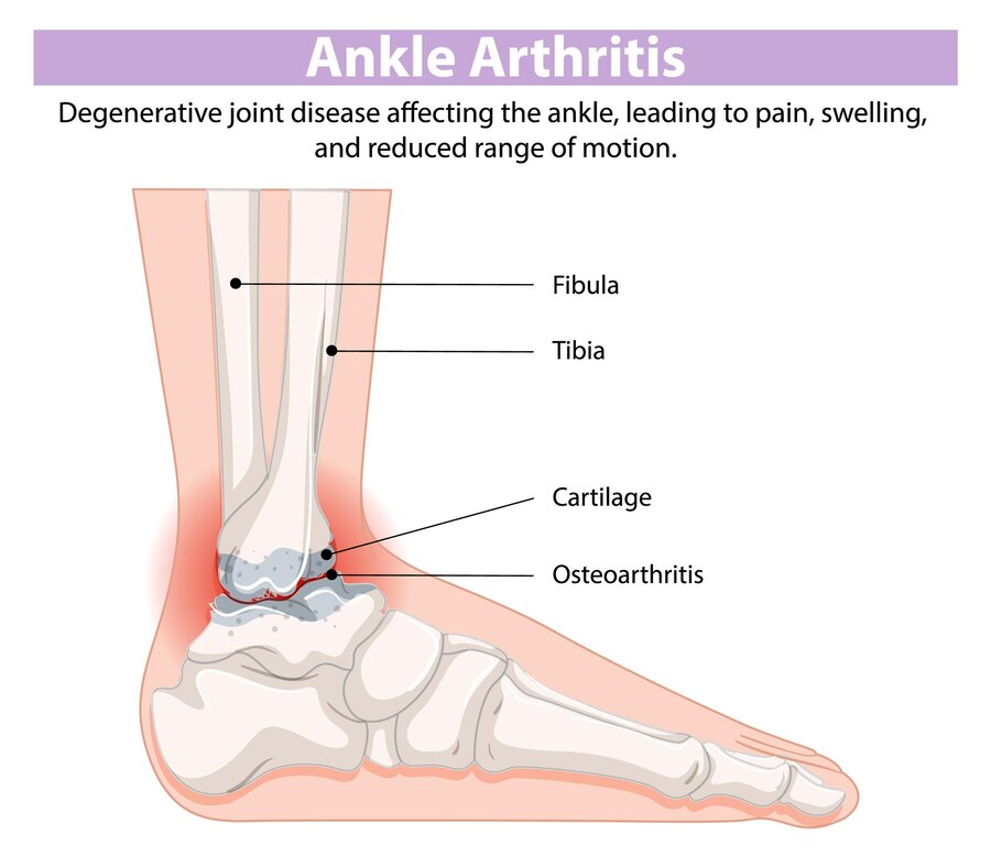 발목 관절염 족관절 ankle arthritis