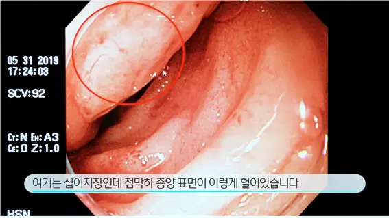 KBS 생로병사의 비밀 822회 소화불량 속쓰림 가슴쓰림 쓰리고 아픈 속 위장질환 상부위장관 SOS