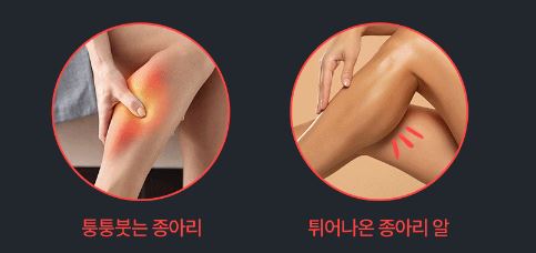 종아리 붓기와 뭉침