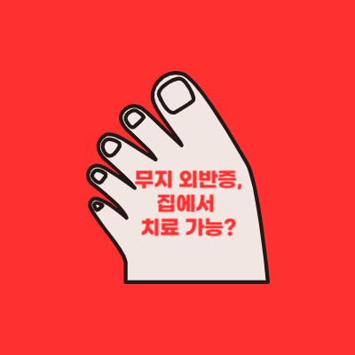  [LIFE] 무지 외반증, 집에서 치료할 수 있을까?