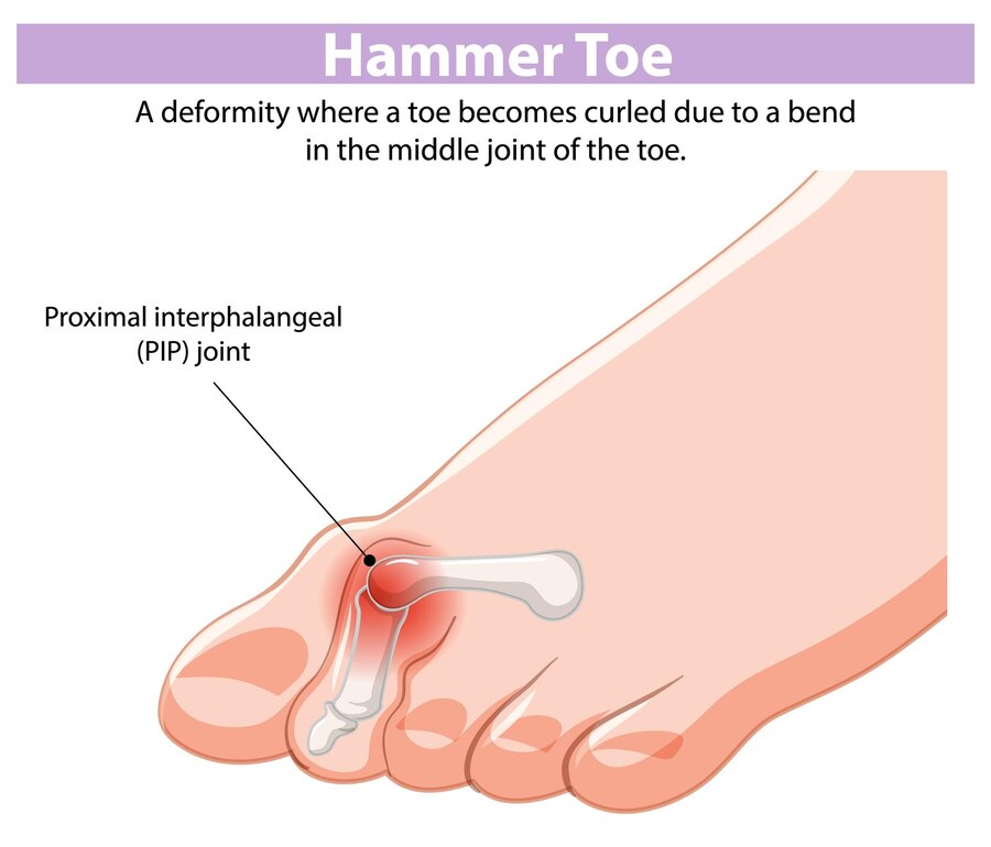 망치발가락, hammer toe, 발가락 변형