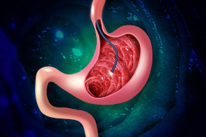 Comparing Upper Endoscopy and Upper Gastrointestinal Series: Choosing the Right Test for You if Endoscopic Examinations Seem Daunting.