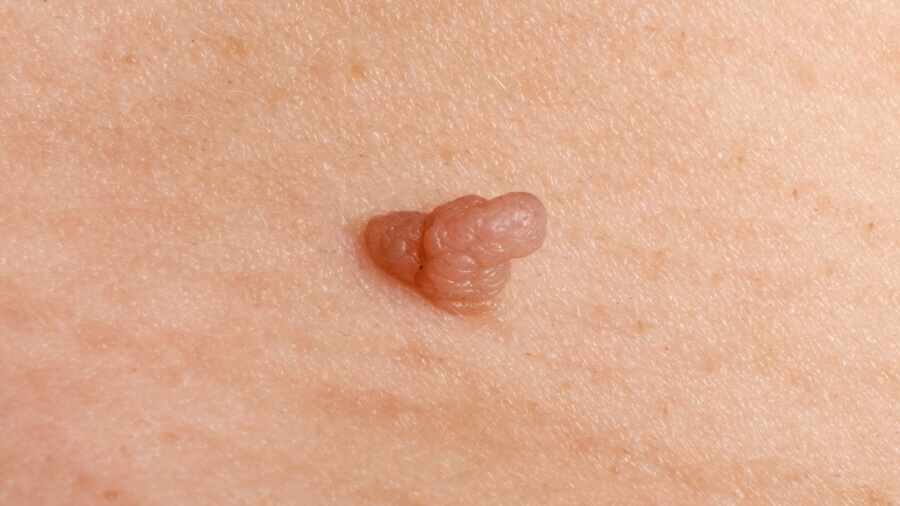  사마귀 생기는 이유? 치료방법 인유두종 바이러스 예방법