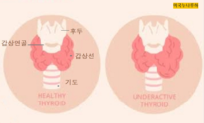  목에 쉰소리가? 갑상선암. 갑상선 종류.