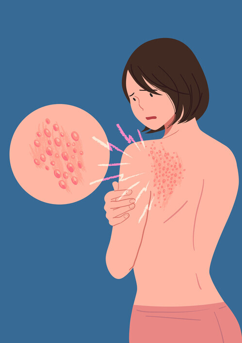 대상 포진. 재발하지 않고 빠르게 회복하는 방법을 알려드리겠습니다! 2