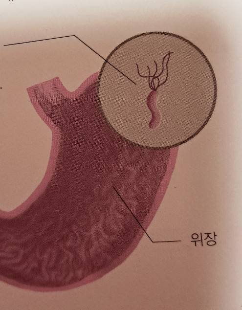 위암 초기증상 위암원인