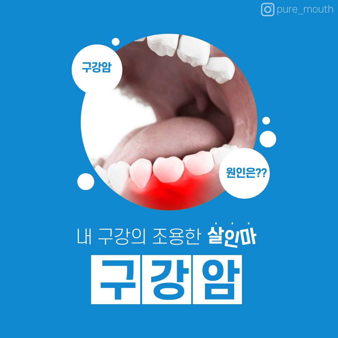  [구강케어] 내 구강의 조용한 암살자 -구강암-