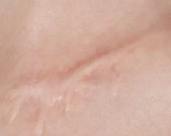 흉터전용 치료 추천 스카덤 겔 효능효과_22