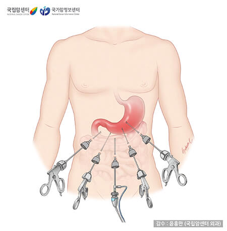 복강경 수술 예 (출처 : 국립암정보센터)