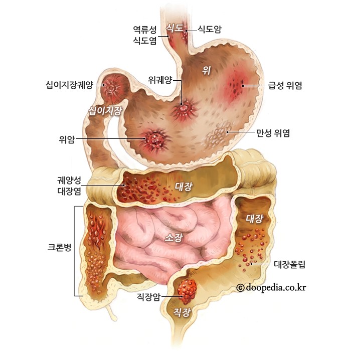  역류성 식도염의 증상과 예방법! 자세히 알아보자!