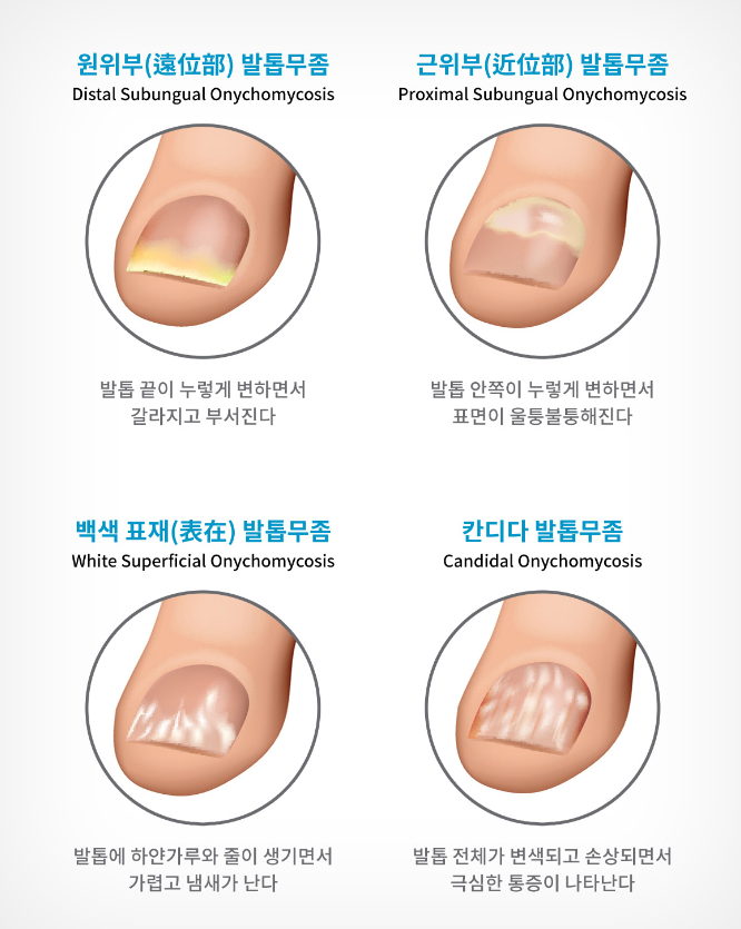 발톱무좀 종류