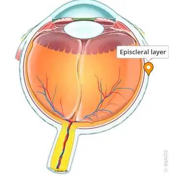 Episcleral-layer-정맥압력-감소