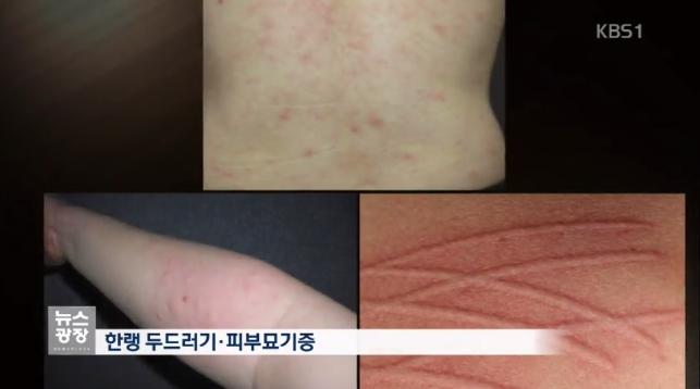 면역력 저하 두드러기 근황 10차 (11.18) 2