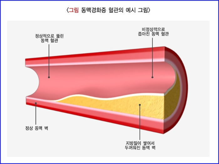 혈관 건강-동맥경화증