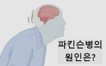 파킨슨병의 원인