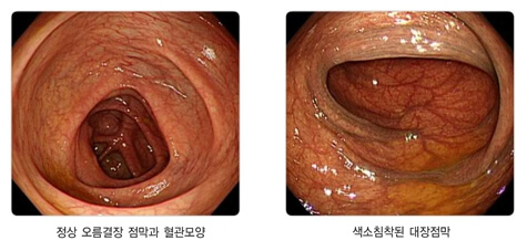 위&middot;대장내시경 동시 검사 후기: 통증&amp;#44; 준비&amp;#44; 결과까지 솔직하게