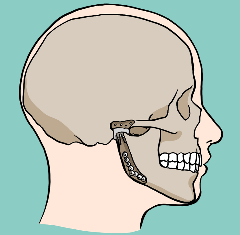 턱 퇴행성 관절염 치료법과 턱관절 스플린트 3종류 비교