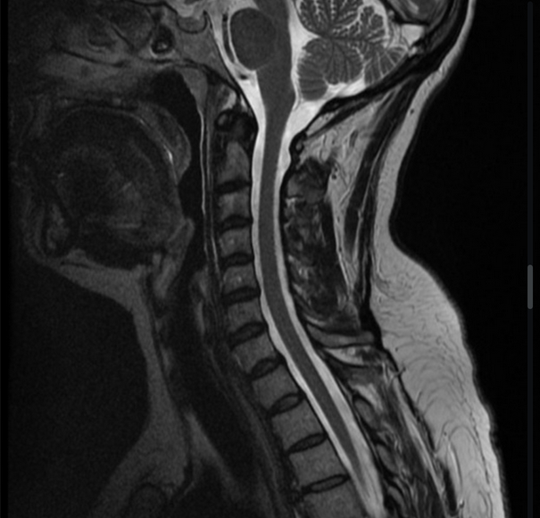 경추 MRI