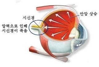 녹내장 증상