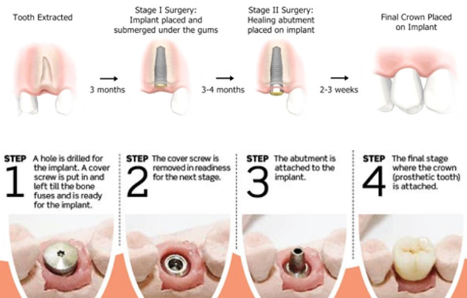 임플란트 시술과정
