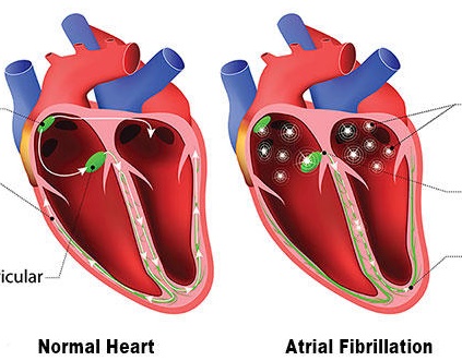 atrial fibrillation 심방세동
