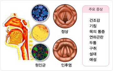 급성 후두염 증상