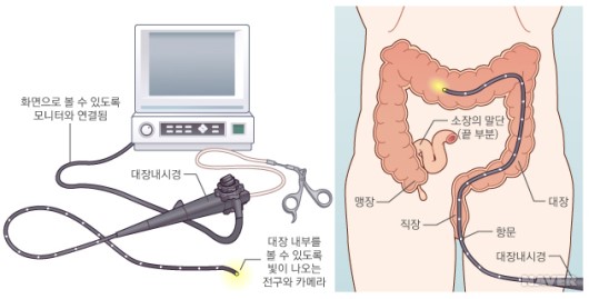  대장내시경[colonoscopy]