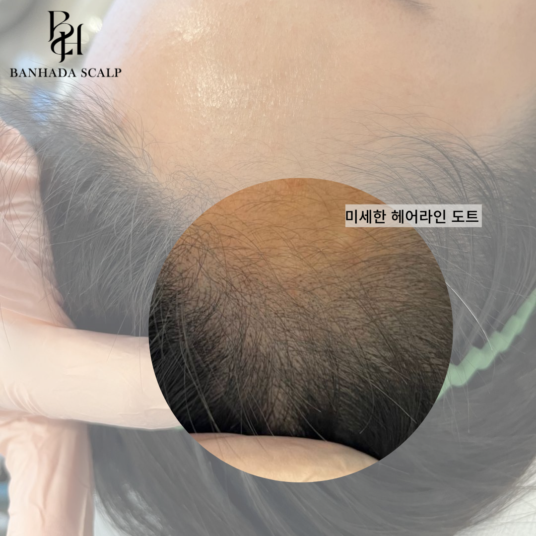 대구 헤어라인교정, 헤어라인반영구, 2