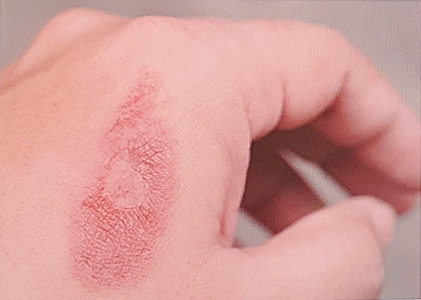 열이나는 이유(위험성) 핫팩 원리 2