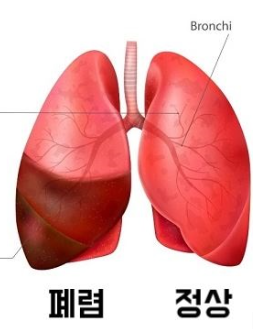 폐렴 증상