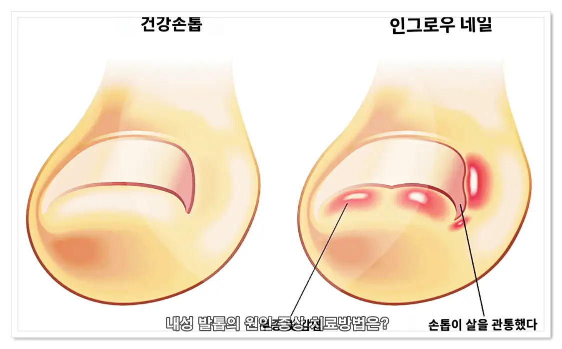 내성 발톱 증상