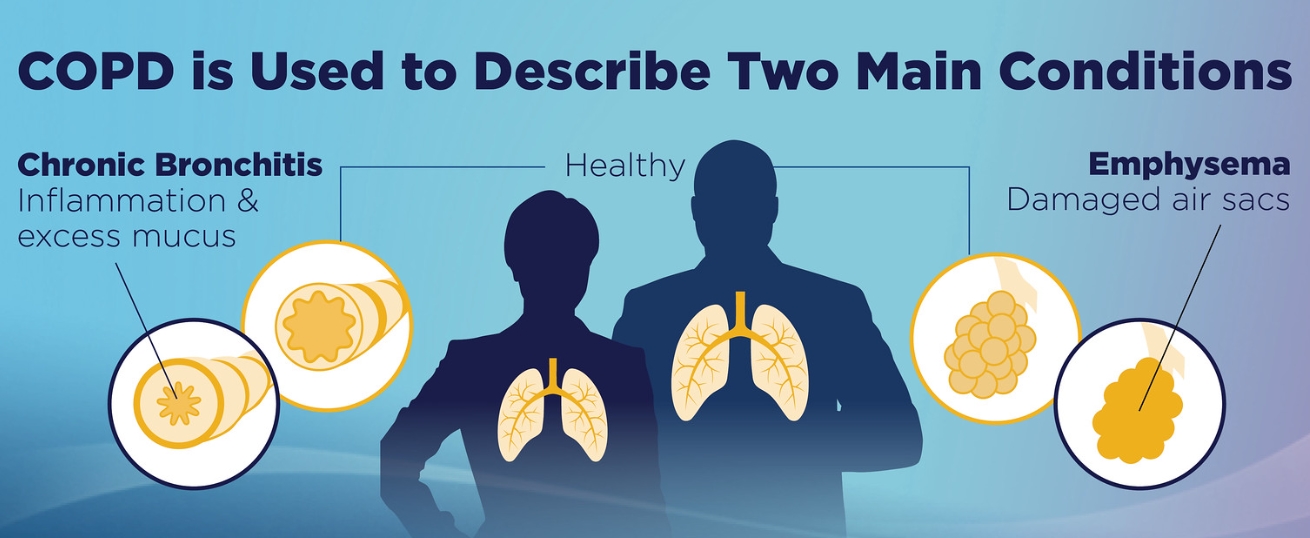  만성 폐쇄성 폐질환(COPD) 증상, 원인, 진단, 좋은 음식, 운동
