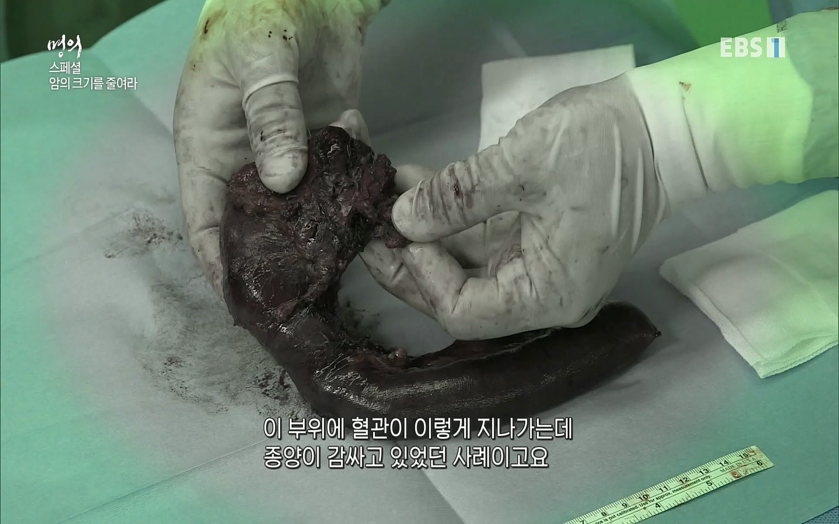 EBS 명의 헬스케어 - TV - 교육의 중심 EBS[명의 스페셜] 공포의 암, 췌장암, 담도암, 담낭암.mp4_20220902_210909.118.jpg