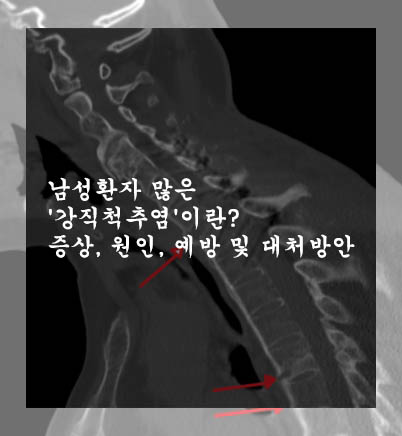  남성환자 많은 '강직척추염'이란?: 증상, 원인, 예방 및 대처방안