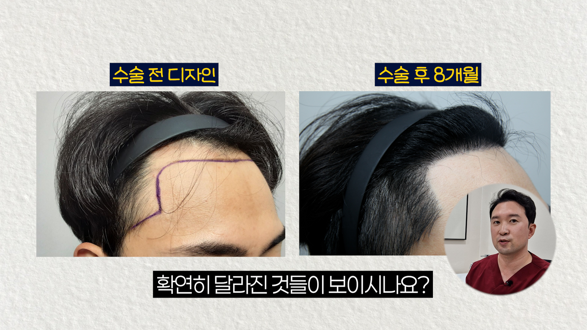진헤어라인 이미지