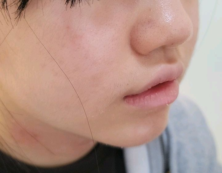 갑자기 생기는 성인아토피