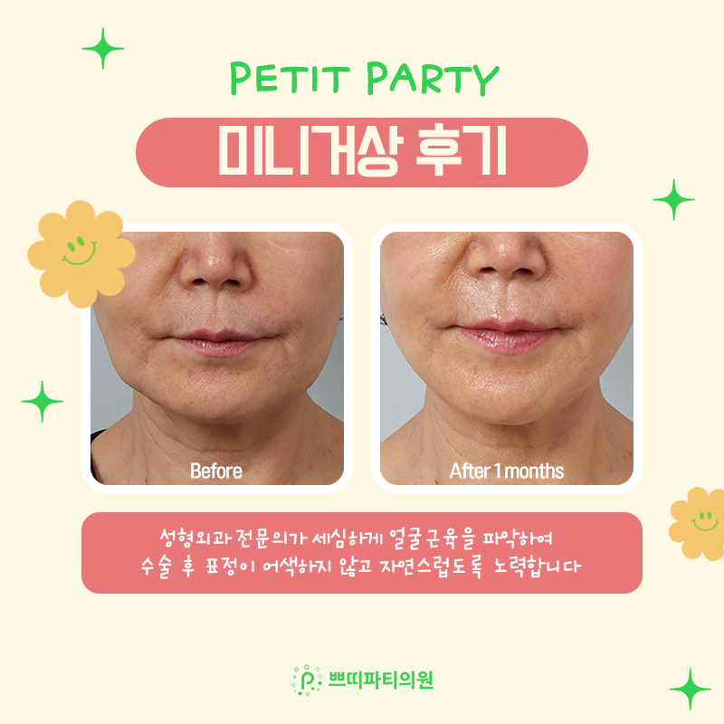  리프팅성형외과 미니거상후기 자연스러운 조화로움이 먼저