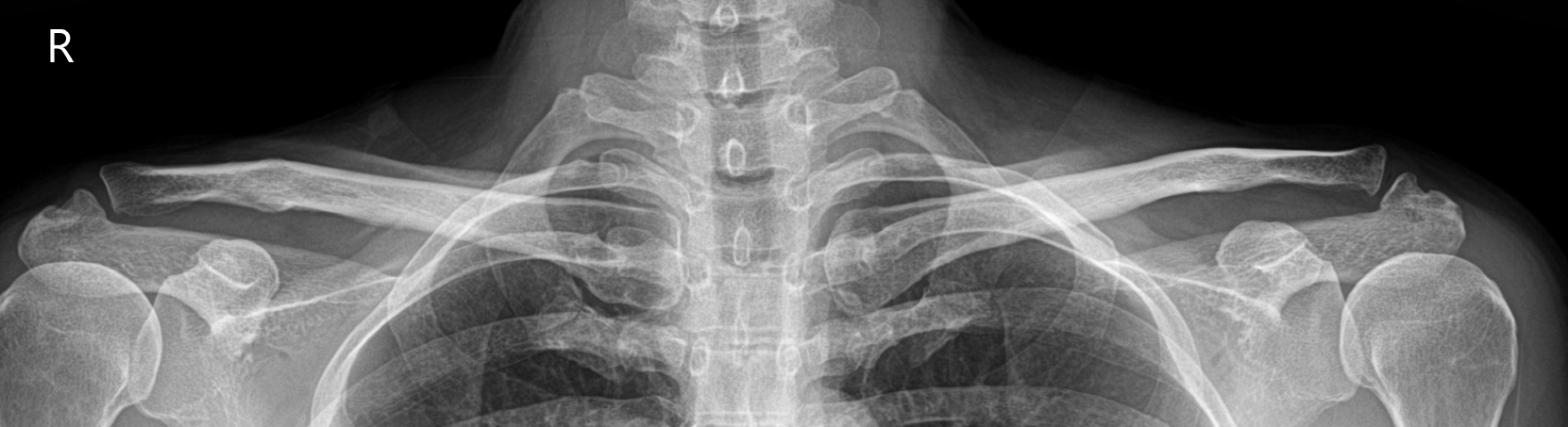 Clavicle AP