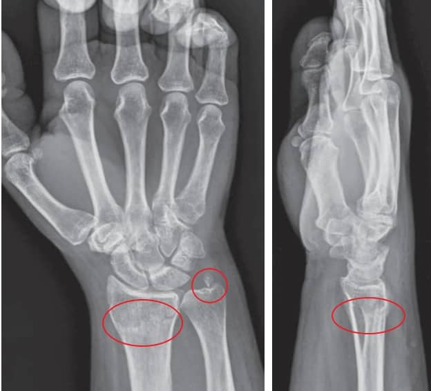 원위부 요골 및 척골 경상돌기 골절 xray