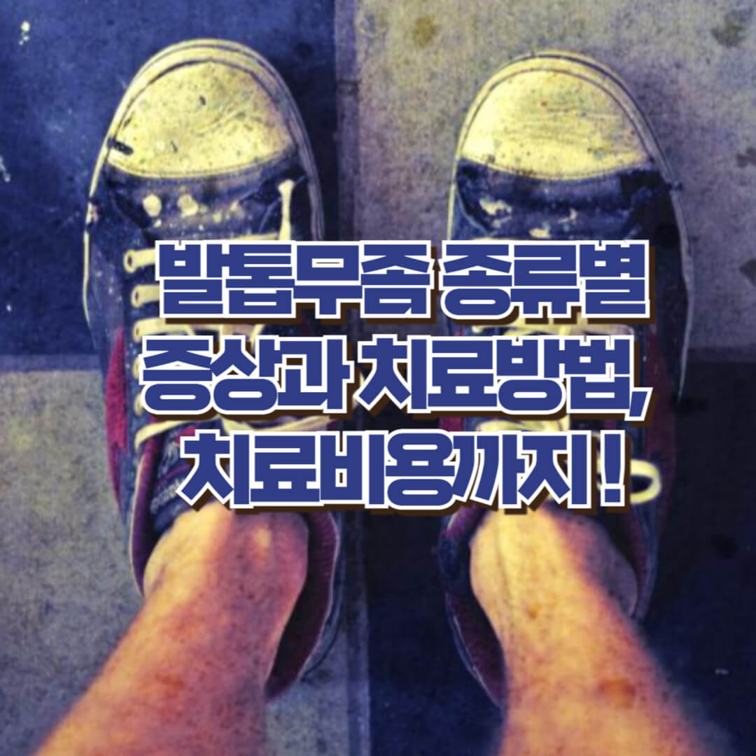 발톱무좀 치료방법