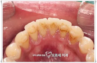 스케일링 후 양치 통증 음식_7