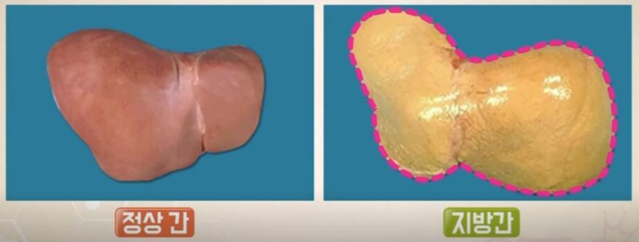 지방간 증상 및 비알콜성 지방간의 원인과 지방간에 좋은 음식 7가지
